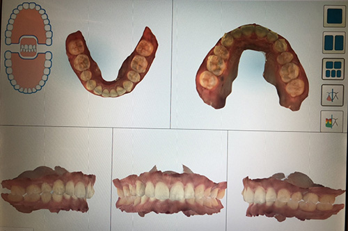口腔内スキャン治療経過