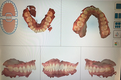口腔内スキャン治療前